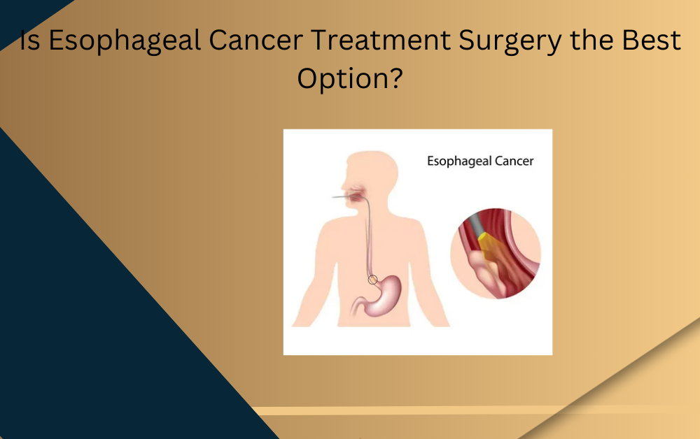 esophageal cancer treatment surgery